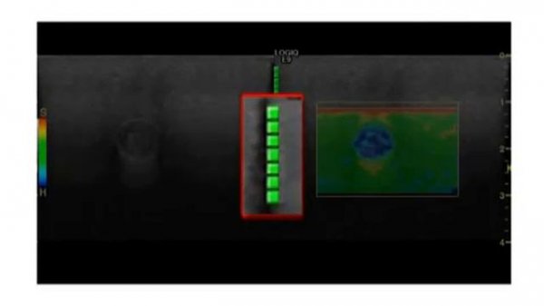 LOGIQ E9 с эластографией — 2010
