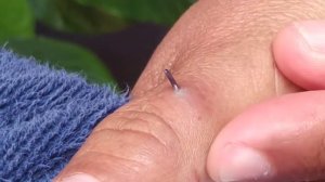 НОВОЕ ВИДЕО 2022  Прыщи давить залипательное (заноза)