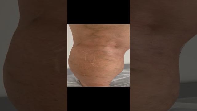 Варикоз на ногах у девушки. Планируем операцию. Лечение варикоза. Флеболог Москва. Флеболог смотреть онлайн