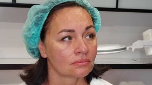 Мезоботокс за 5 минут.