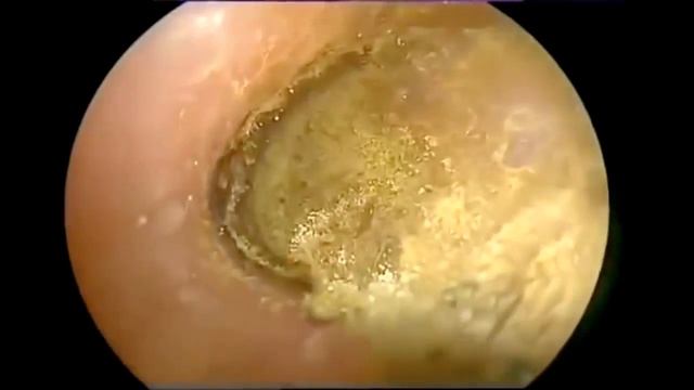 Удаление грибка из уха смотреть онлайн