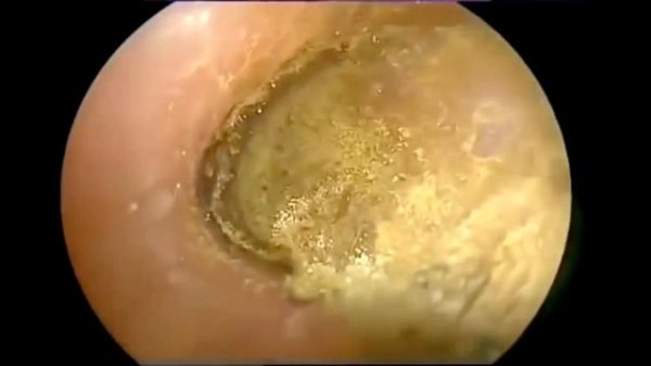 Удаление грибка из уха