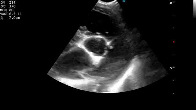 Дирофиляриоз у собаки УЗИ (Dirofilariasis in dog ultrasound) смотреть онлайн