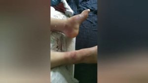 Реабилитация после ахиллопластики и артролиза