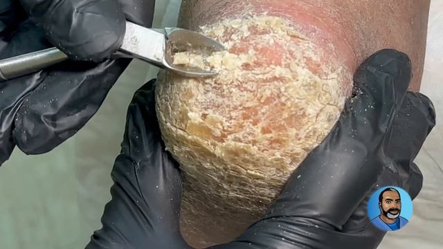 Crusty Heels: Removing Thick Callus And Scales From The Heels