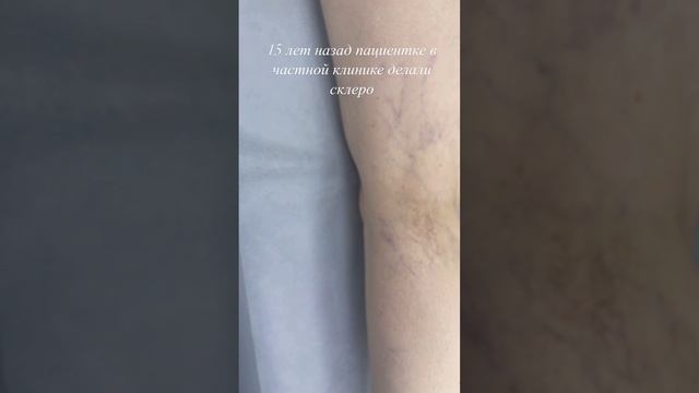 Пигментация после склеротерапии. Сосудистая сетка на ногах. Флеболог Москва. Флеболог.