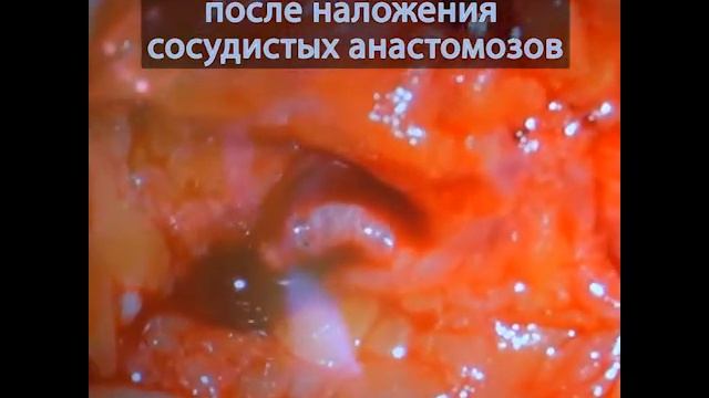 Лечение асептического некроза ладьевидной кости смотреть онлайн