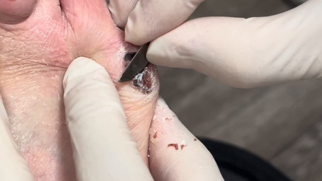 Is A Blood Callus Dangerous?? (Satisfying Debridement) смотреть онлайн