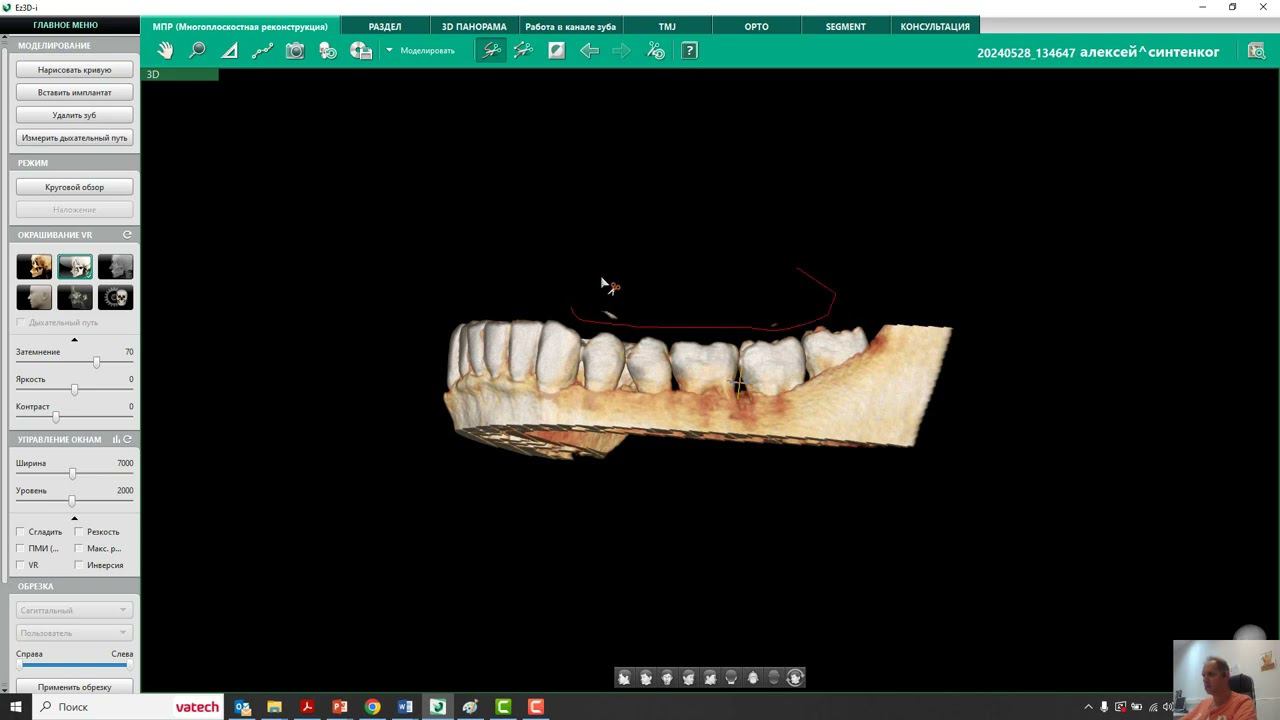 Экспорт DICOM в STL смотреть онлайн