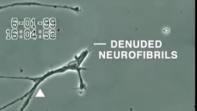 Как ртуть разрушает нейроны головного мозга