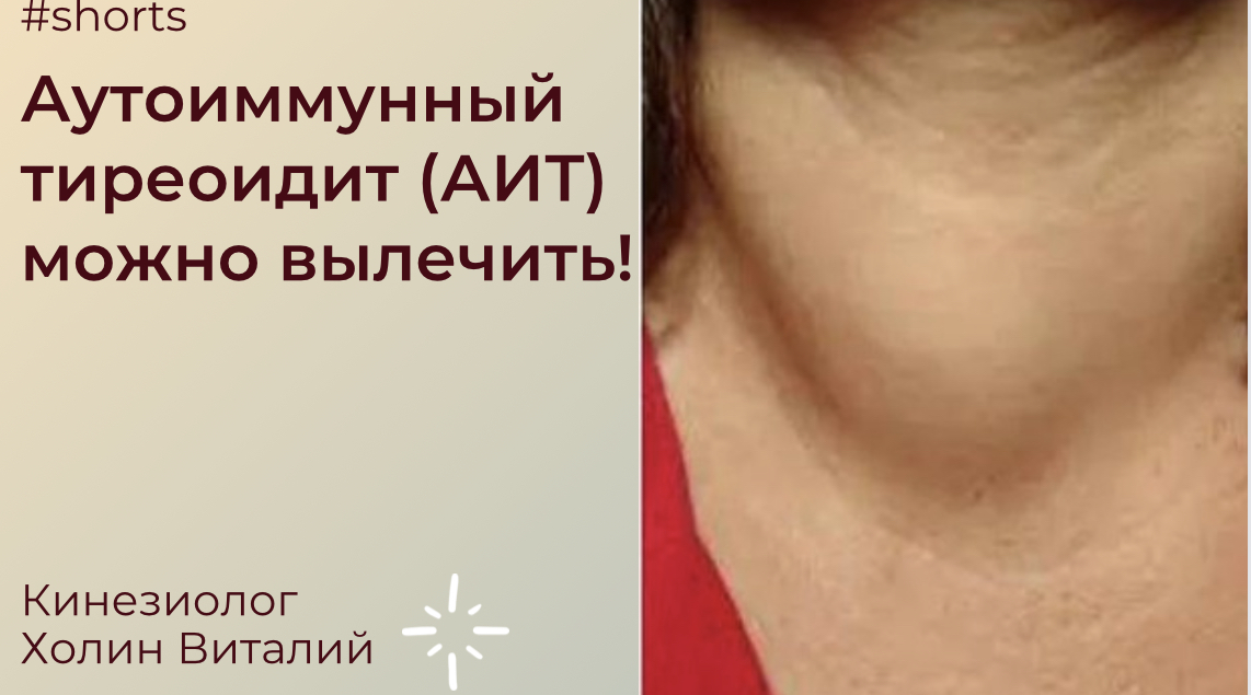 Аутоиммунный тиреоидит (АИТ) можно вылечить! смотреть онлайн