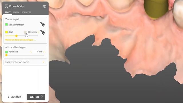 Tutorial | Volldigitale Implantatkrone in Exocad смотреть онлайн
