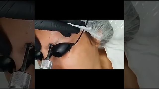 Удаление татуажа бровей смотреть онлайн