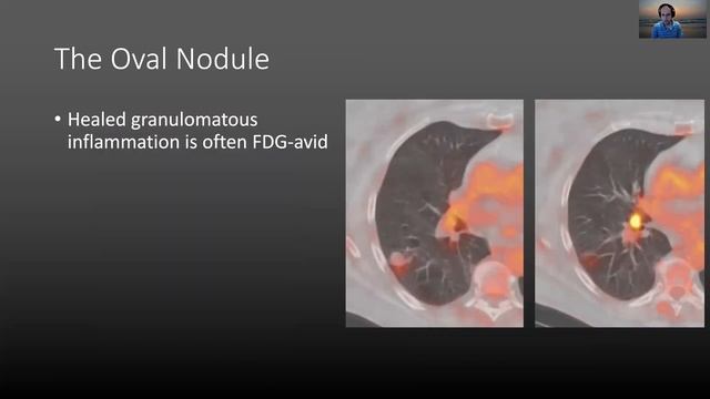 Approach to the solitary pulmonary nodule смотреть онлайн