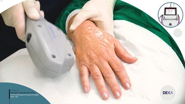 DEKA Luxea - Intense Pulsed Light Lilac Photo Rejuvenation Treatment 02 смотреть онлайн