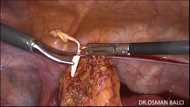 Direct Umbilical Trocar Insertion and Laparoscopic Removal of Intra Abdominal IUD смотреть онлайн