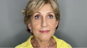 Круговая подтяжка лица SMAS лифтинг: ДО и ПОСЛЕ.