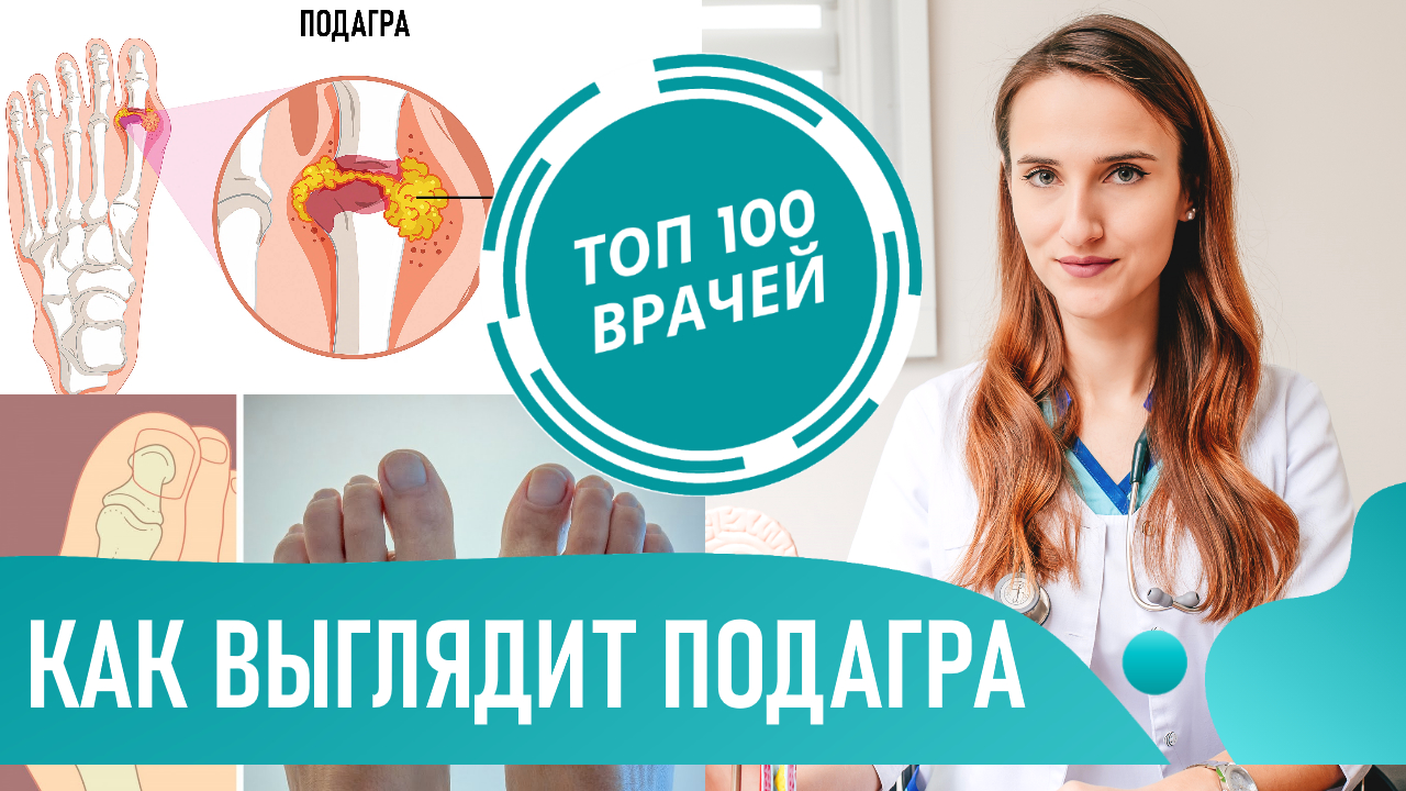Подагра: признаки и симптомы. Как выглядит подагра (фото 1-6). Приступ подагры на ногах смотреть онлайн