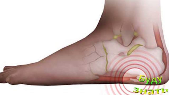 ВЫ забудете, что была ПЯТОЧНАЯ ШПОРА!!! смотреть онлайн