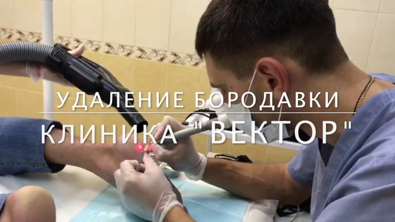 ПОДОШВЕННЫЕ БОРОДАВКИ - процедура удаления лазером смотреть онлайн