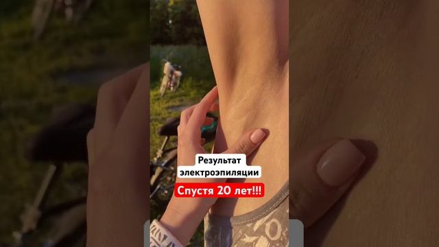 Подмышка после электроэпиляции через 20 лет смотреть онлайн