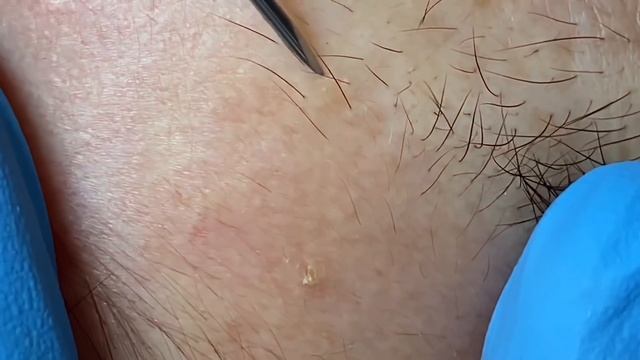 Before beauty treatment clean blackheads . смотреть онлайн