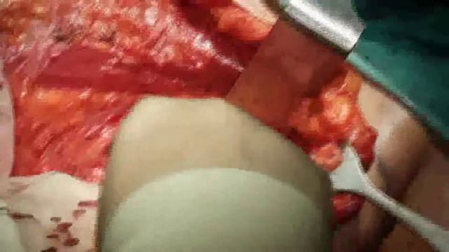 How To Operate - Axillary Node Clearance смотреть онлайн
