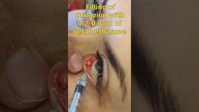 Chalazion treatment with steroid injection | Халязіон. Ін'єкція стероїда смотреть онлайн