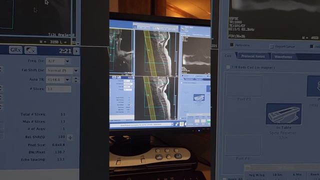 Cervical Spine MRI on a GE Voyager 1.5T scanner смотреть онлайн