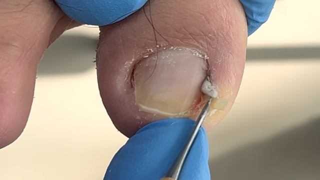 Crowded ingrown nails, professionally trimmed【Xue Yidao】 смотреть онлайн