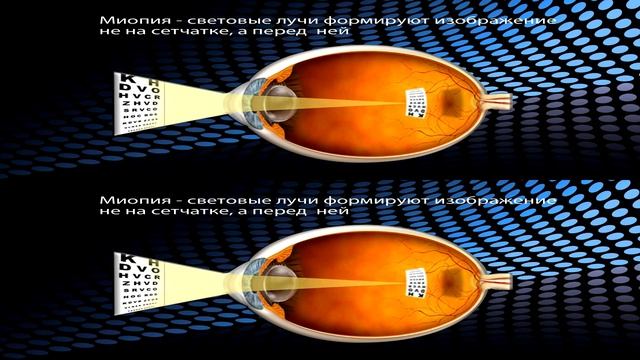Лазерная коррекция зрения смотреть онлайн