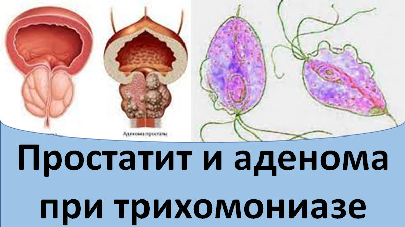 Простатит и аденома простаты при трихомониазе смотреть онлайн