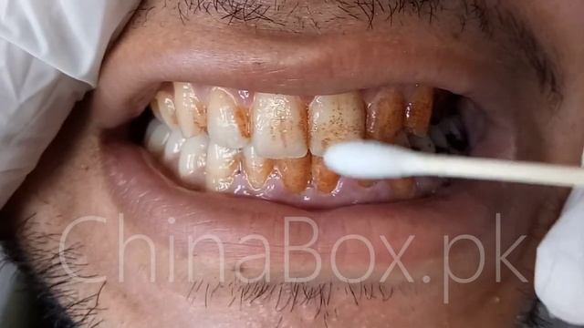 LA PERCA | LANBENA teeth whitening essence -Homely.pk Online shopping смотреть онлайн