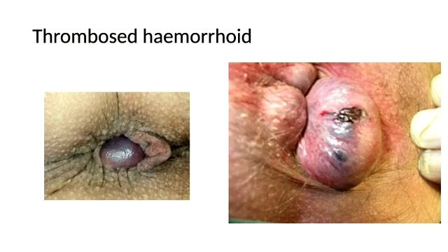 Informative Session On The Wide Prevalent Issue Of PILES - Dr.Senthil Ganapathy, GEM Hospitals