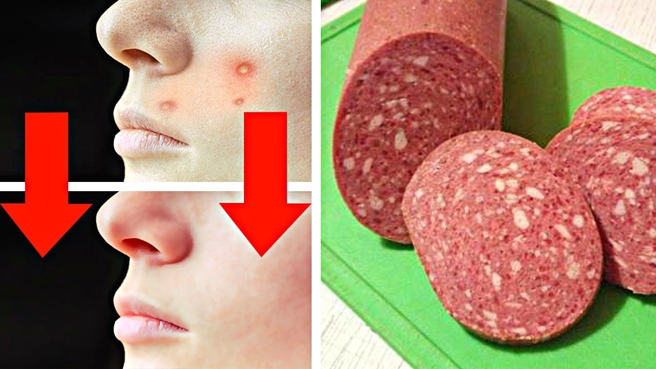 10 Способов Как Избавиться От Прыщей За 1 День смотреть онлайн