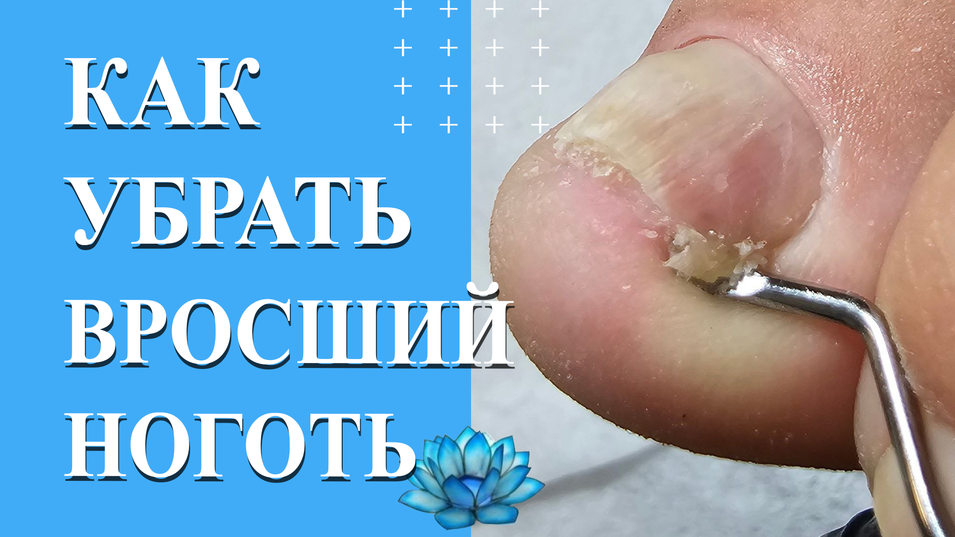 Вросший ноготь на большом пальце ноги. Удаление вросшего ногтя. смотреть онлайн