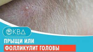 ? Прыщи или фолликулит головы. Клинический случай №905