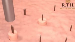 Трансплантация волос методом FUE☀️