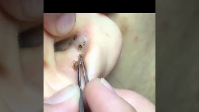 Giant Ear Acne Removal Blackhead!\Удаление гигантских угрей! Remove WoW