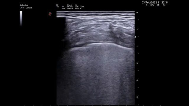 Covid пневмония смотреть онлайн