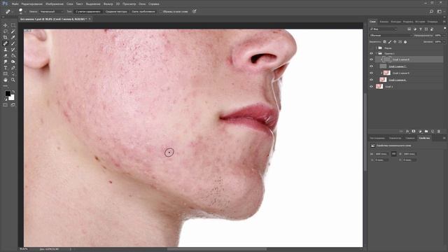 Убираем сложные прыщи в photoshop смотреть онлайн
