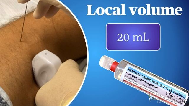 iPACK Block (Interspace Between the Popliteal Artery and Capsule of the Knee) смотреть онлайн