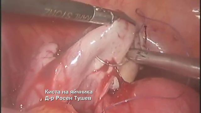 Ovarian cyst / Киста на яйчника - Rossen Tushev M. D смотреть онлайн