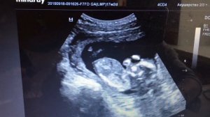 2D УЗи Ребёнок пинается 14 недель
