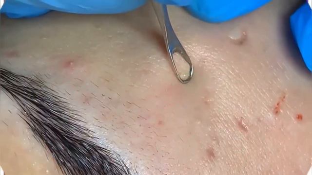 Satisfying Blackhead Removal | removing cystic acne | чёрные точки | прыщи выдавливание| смотреть онлайн