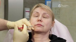 Коррекция губоподбородочных морщин филлером ArtFiller (Арт Филлер)