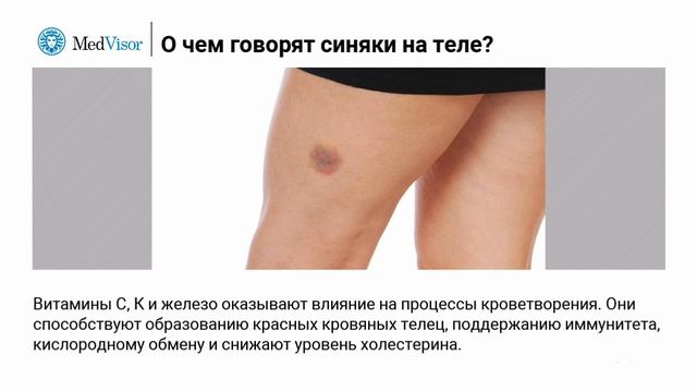 О чем говорят синяки на теле? смотреть онлайн