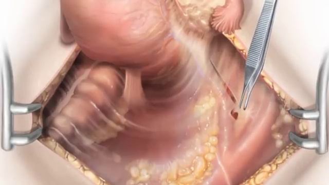 uterine artery ligation desktop смотреть онлайн