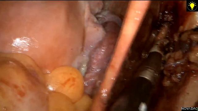 sentinel lymph node mapping with laparoscopic surgical staging in early stage endometrial cancer смотреть онлайн