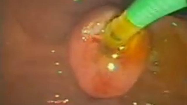 14.1. Эндоскопическая ретроградная панкреатохолангиография...